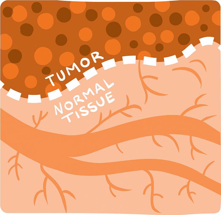 Illustration showing a clear line between tumor tissue and normal tissue Illustration showing a clear line between tumor tissue and normal tissue.