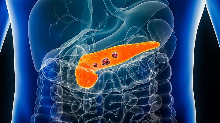 Illustration of a pancreas with tumors. Illustration of a pancreas with tumors.